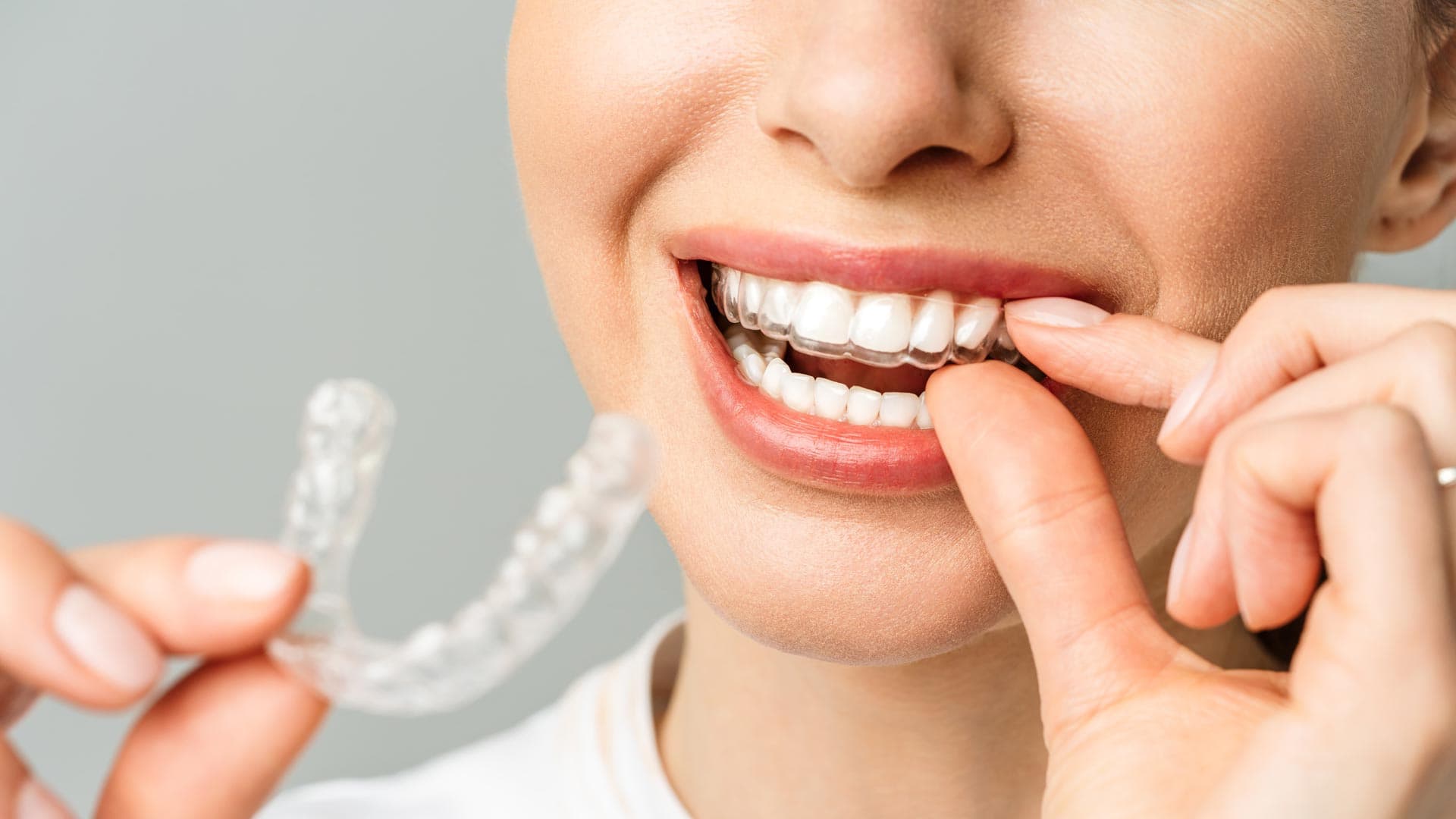 ¡Brinde una solución cómoda y estética para sus pacientes con nuestras férulas!