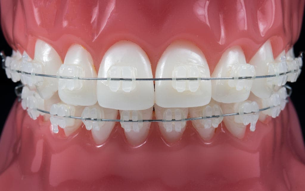 Más información sobre ortodoncia fija