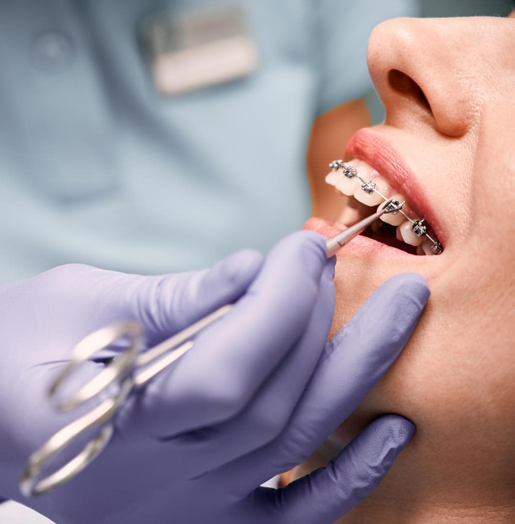 Nuestros modelos de aparatología fija en A Coruña